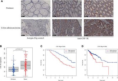 High Expression of CSF-1R Predicts Poor Prognosis and CSF-1Rhigh Tumor-Associated Macrophages Inhibit Anti-Tumor Immunity in Colon Adenocarcinoma